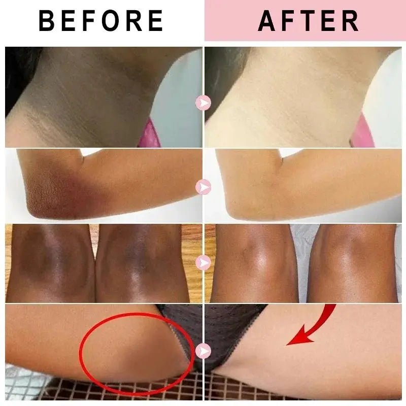Private Parts Underarm Whitening Cream Bleaching Serum Whiten Butt Knee Brighten Inner Thigh Intimate Parts Dark Remove Melanin
